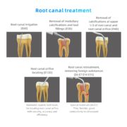 AIR POLISHER ROOT CANAL